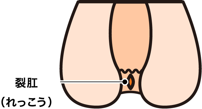 裂肛(れっこう・切れ痔) ANAL FISSURE
