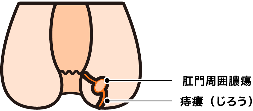 痔瘻(じろう・あな痔) ANAL FISTULA