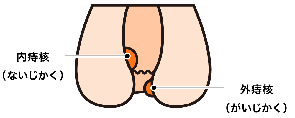 痔核（じかく・いぼ痔 HEMORRHOID