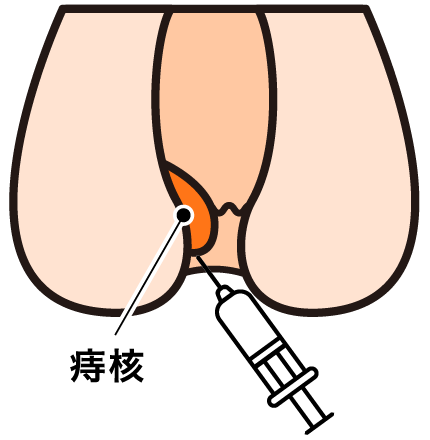 ①4カ所に硬化剤を注入します。