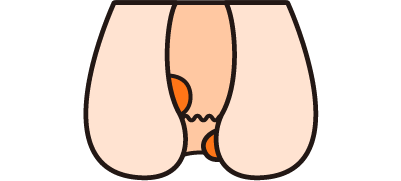 1.痔核（じかく・いぼ痔）