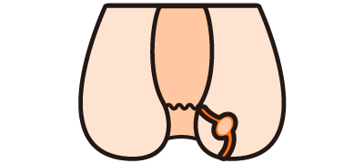 3.痔瘻（じろう・あな痔）